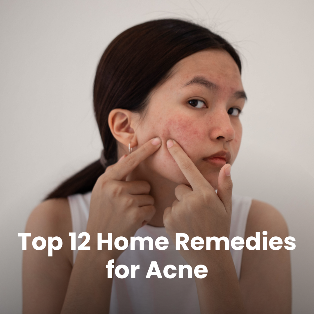 Top 12 Home Remedies for Acne